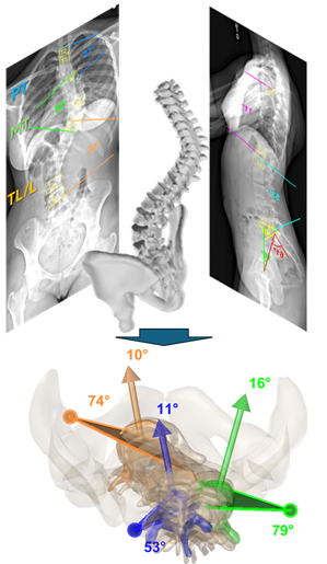 Exemple de classification d'une scoliose